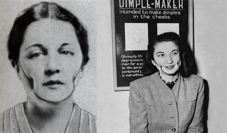 In 1936, Isabella Gilbert of Rochester, NY developed a machine to create dimples. In order to create the desired indentations, this device was worn over the cheeks while two knobs press into the cheeks. According to the advertisement, after continual use, the device soon make a fine set of dimples. The American Medical Association argued that the Dimple Maker would not make dimples and that prolonged use of the devise may actually cause cancer. (History By Zim) In 1936, Isabella Gilbert of Rochester, NY developed a machine to create dimples. In order to create the desired indentations, this device was worn over the cheeks while two knobs press into the cheeks. According to the advertisement, after continual use, the device soon make a fine set of dimples. The American Medical Association argued that the Dimple Maker would not make dimples and that prolonged use of the devise may actually cause cancer. (History By Zim)